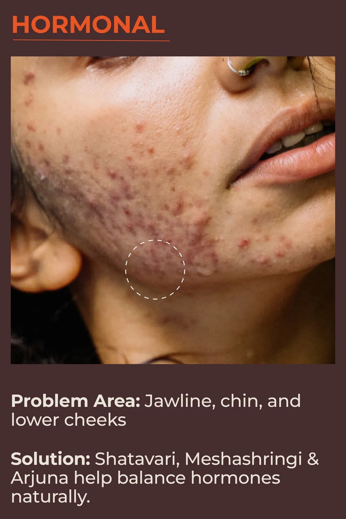 Hormonal acne: jawline, chin and lower cheeks. Shatavari, Meshashringi and Arjuna help balance hormones naturally