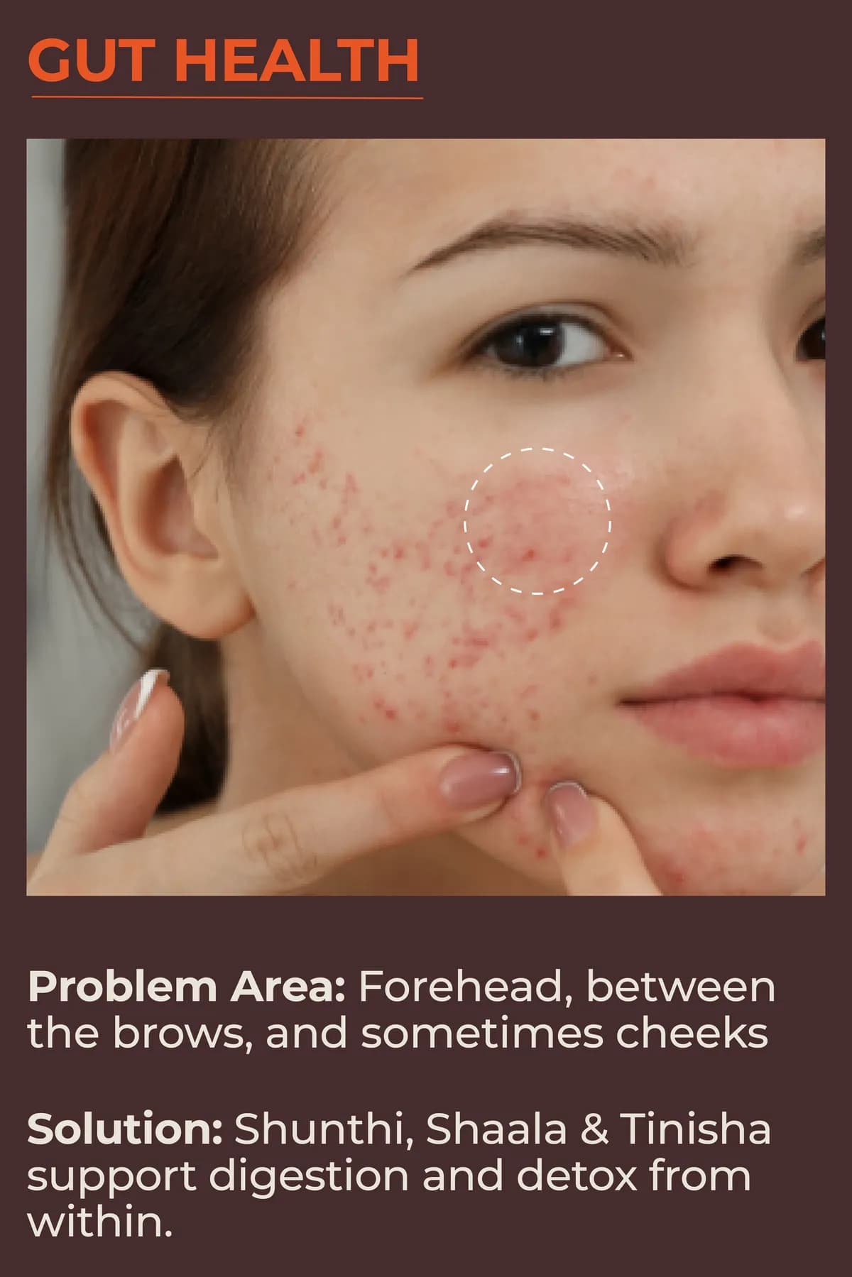 Gut health: forehead, between the brows and sometimes the cheeks. Shunthi, Shaala and Tinisha support digestion and detox